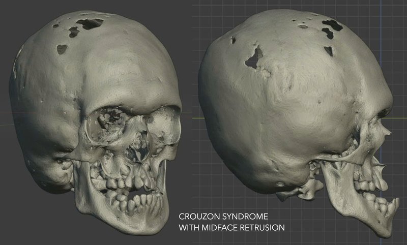 Craniosynostosis