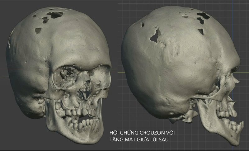 Dị tật dính khớp sọ sớm