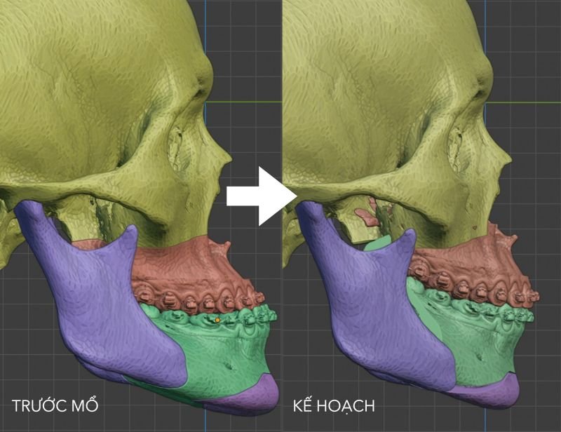 Lên kế hoạch 3D phẫu thuật chỉnh hình xương hàm