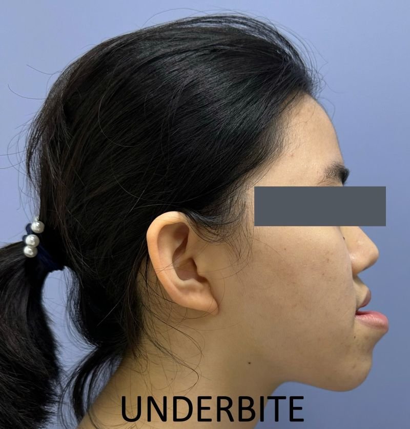 Orthognathic surgery before and after