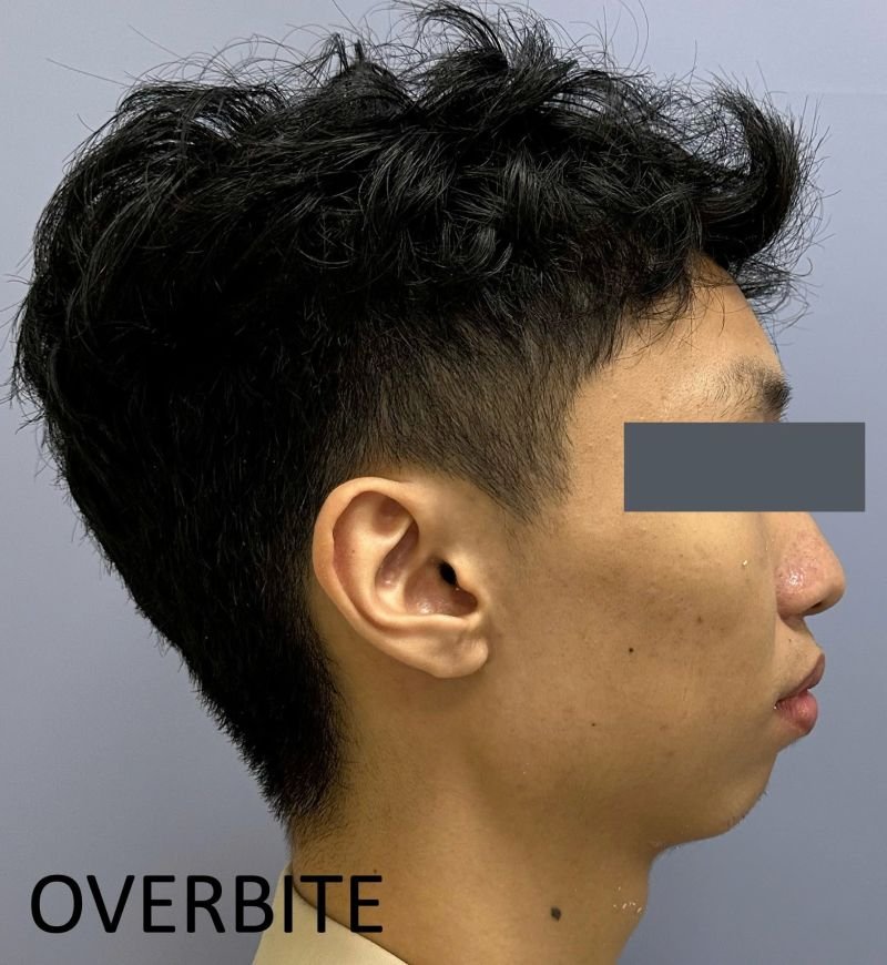 Orthognathic surgery results