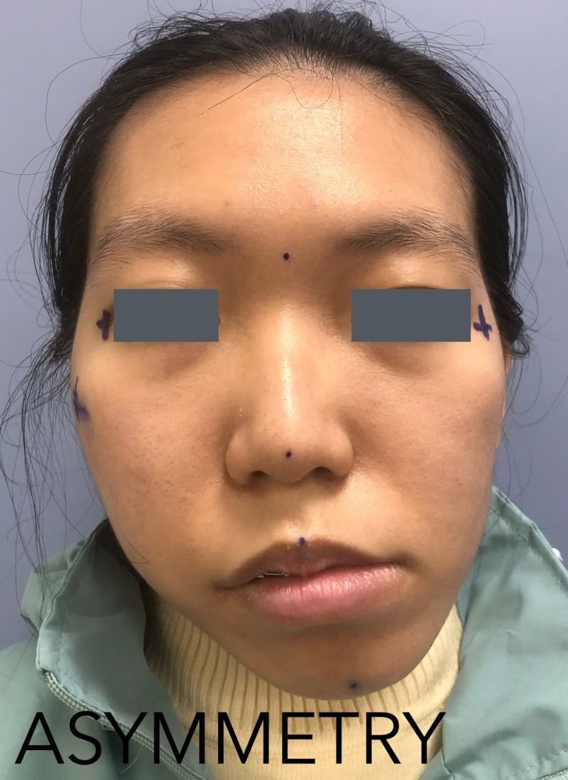 Orthognathic surgery clinical case