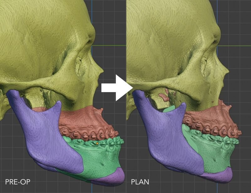 3D planning for orthognathic surgery
