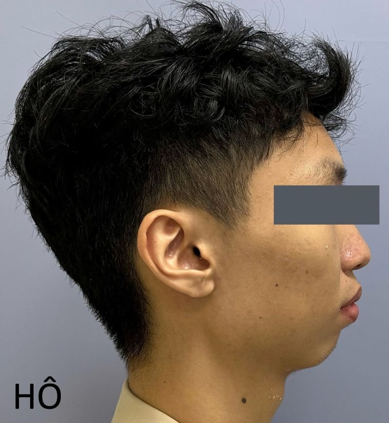 Kết quả phẫu thuật chỉnh hình xương hàm