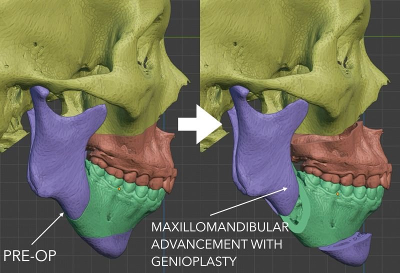 Surgical treatment for obstructive sleep apnea