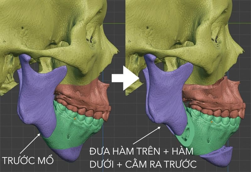Phẫu thuật điều trị ngưng thở khi ngủ