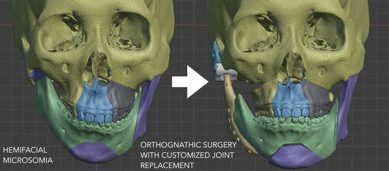 TMJ surgery combined with orthognathic surgery