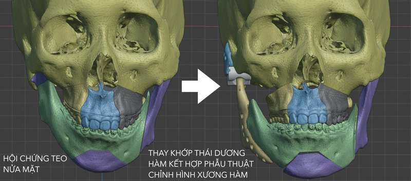 Phối hợp phẫu thuật khớp thái dương hàm với chỉnh hình xương hàm