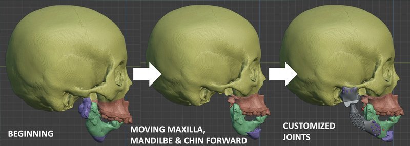 Patient-specific total temporomandibular joint prosthesis