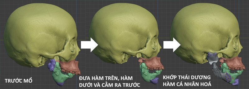 Khớp thái dương hàm toàn bộ thiết kế cá nhân hoá