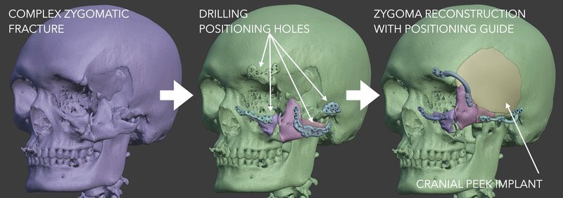 3D planning in maxillofacial trauma