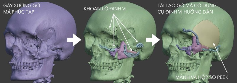 Lên kế hoạch 3D trong chấn thương hàm mặt