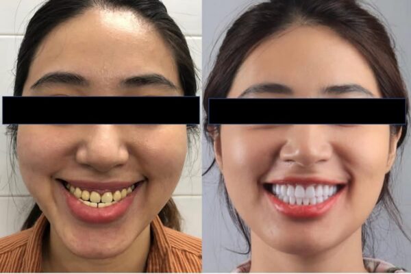 Điều trị liên chuyên khoa cho bệnh nhân sai lệch xương hàm sau chỉnh nha ngụy trang và phục hình toàn hàm