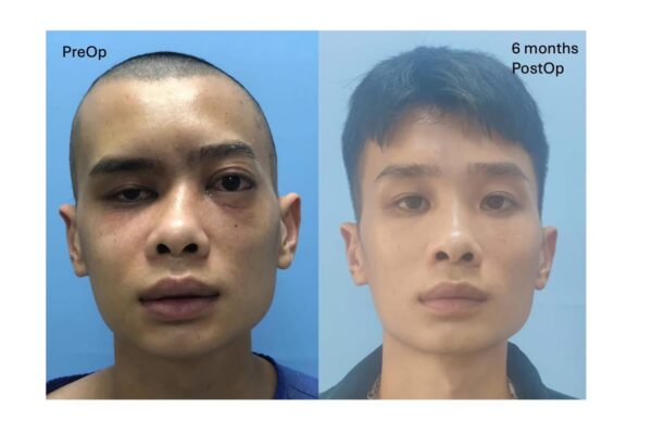 Tái tạo chấn thương phức hợp mũi – sàng – ổ mắt hai bên