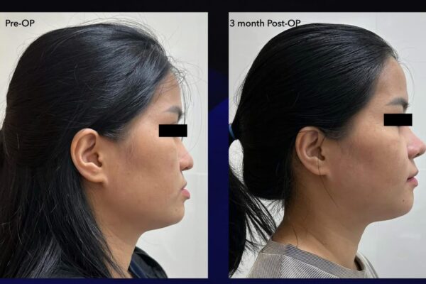 Phẫu thuật sai khớp cắn loại iii trên bệnh nhân có ngưng thở khi ngủ tắc nghẽn