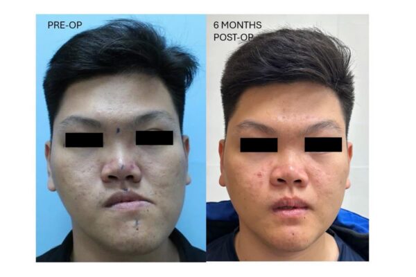 Chin wing osteotomy trong điều trị bất đối xứng xương hàm dưới