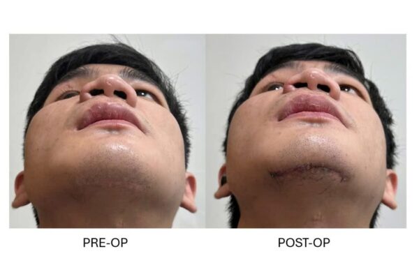 Ứng dụng thiết bị định vị trong tái tạo ổ mắt phức tạp