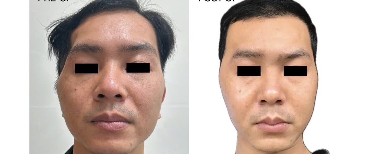 Tái tạo lõm thái dương sau tiêu xương sọ bằng mảnh ghép peek cá nhân hóa
