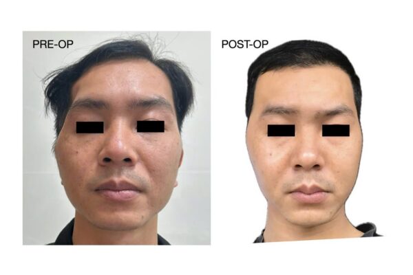 Tái tạo lõm thái dương sau tiêu xương sọ bằng mảnh ghép peek cá nhân hóa