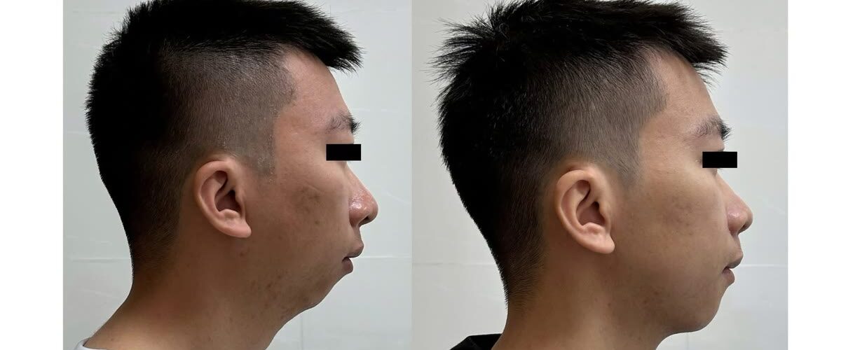 Phẫu thuật tiến hai hàm trong điều trị ngưng thở khi ngủ tắc nghẽn