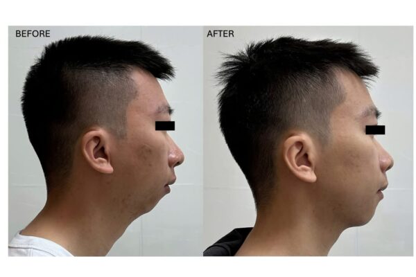 Phẫu thuật tiến hai hàm trong điều trị ngưng thở khi ngủ tắc nghẽn