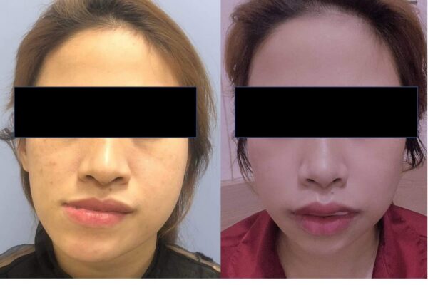 Điều trị lệch mặt do u xương sụn lồi cầu