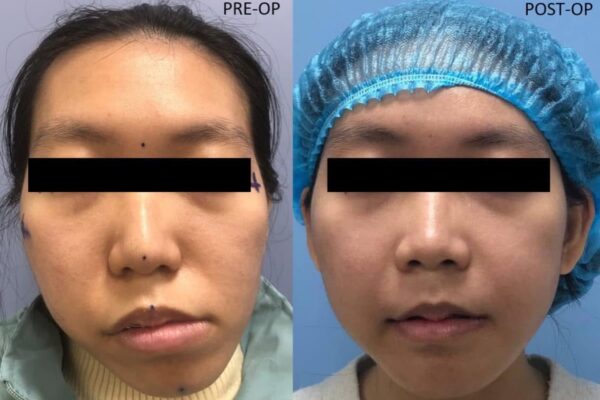 Phẫu thuật chỉnh hình xương hàm cho hô hai hàm, cười hở lợi và lệch mặt