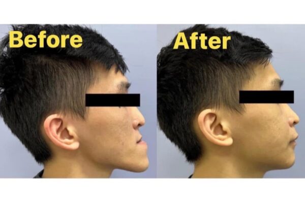 Tư thế đầu tự nhiên trong lập kế hoạch phẫu thuật chỉnh hình xương hàm