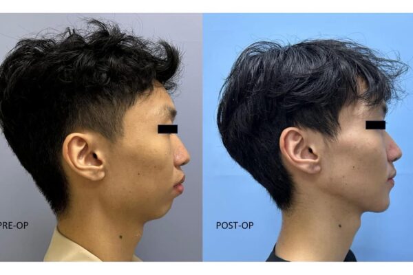Điều trị sai khớp cắn loại ii kết hợp hô xương ổ răng hai hàm