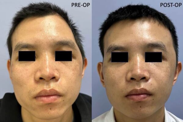 Tái tạo khuyết hổng hộp sọ cá nhân hóa kết hợp phục hồi đường nét khuôn mặt